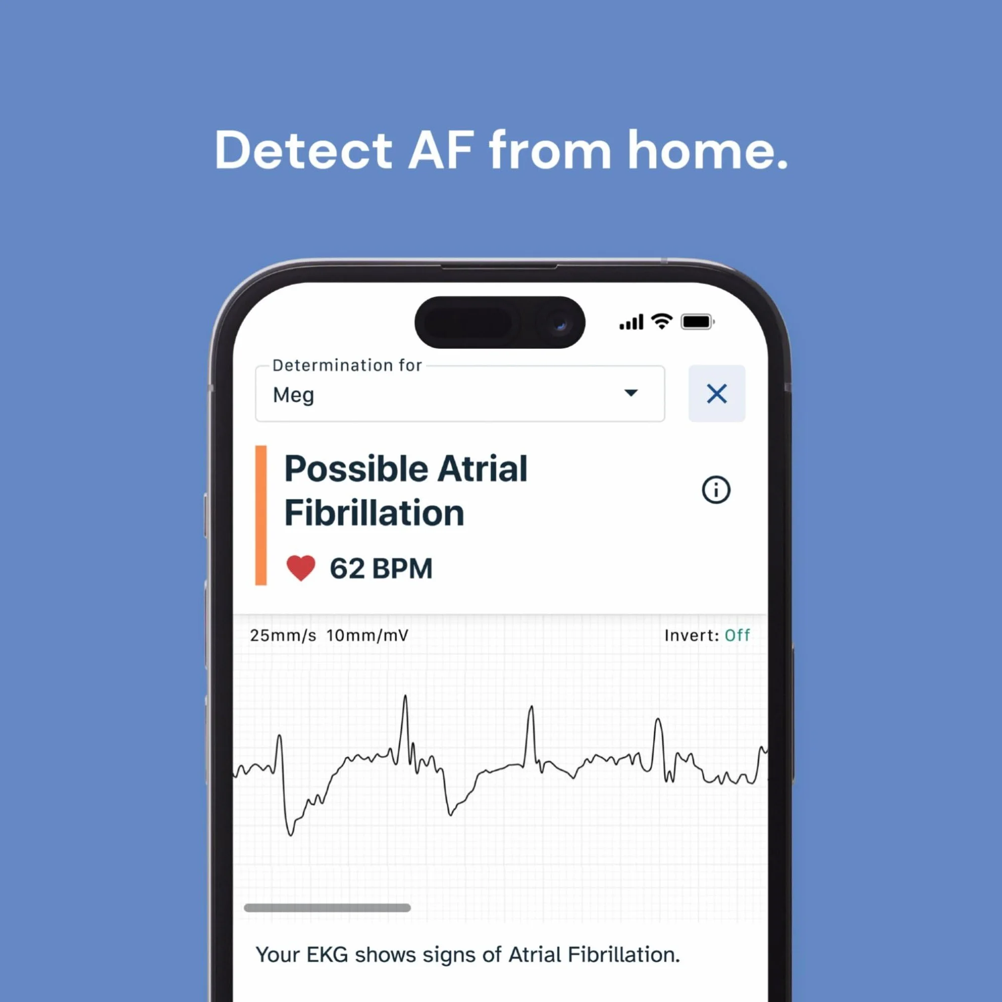 KardiaMobile 1-kanałowy czujnik tętna EKG + 1 miesiąc Kardiacare – zapis EKG w domu – wykrywa migotanie przedsionków – natychmiastowe rezultaty w 30 sekund – działa z większością smartfonów