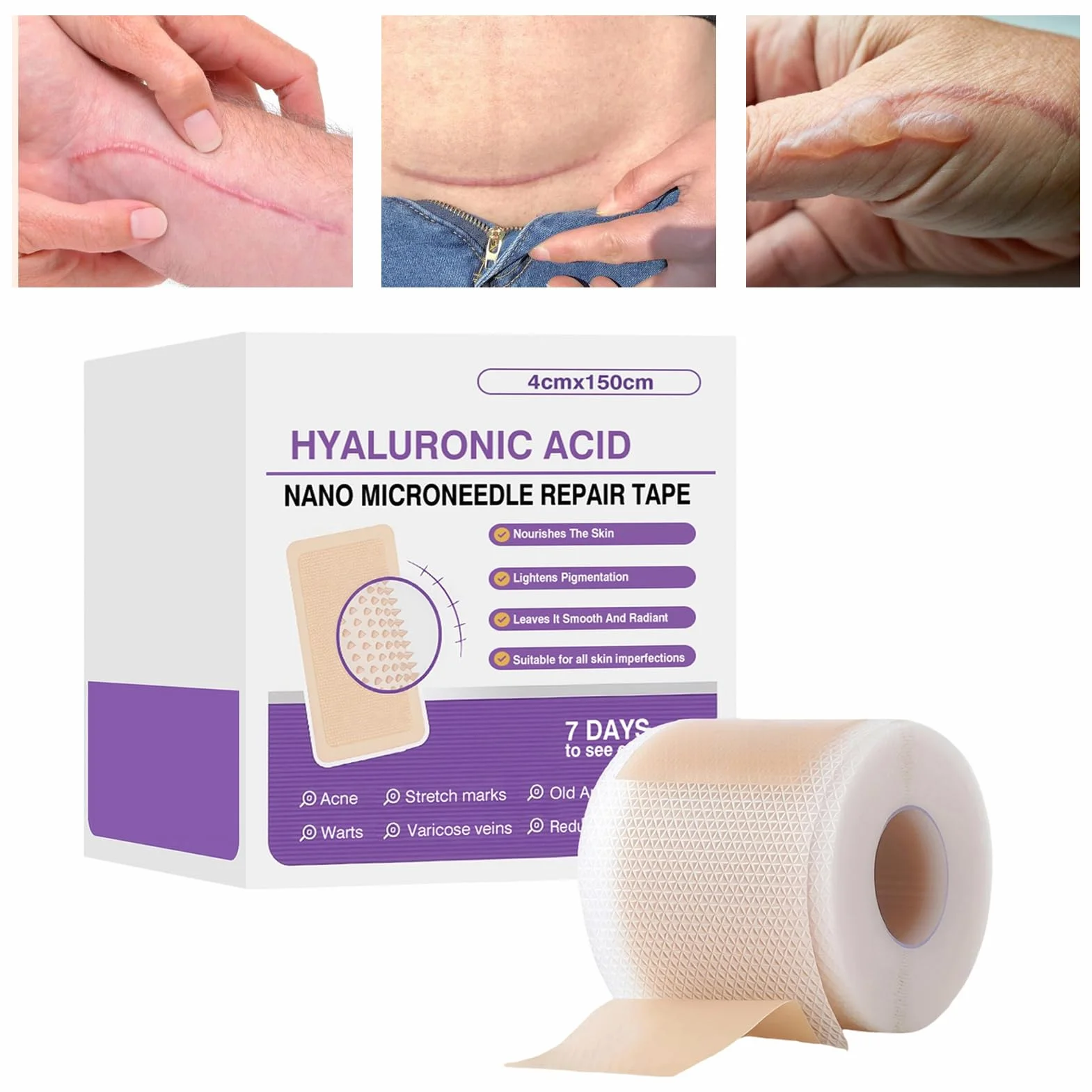 Silicone Scar Tape 4x150cm Reusable Elastic Skin Patch for Face Body Stretch Marks Burn Care
